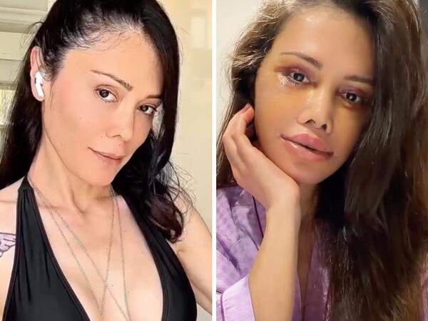 Əməliyyatla üzünü dəyişdirdi, tanınmaz hala düşdü - <span class="color_red">FOTO</span>