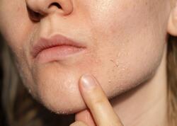 Soyuq havada quru dəri problemindən necə xilas olaq?