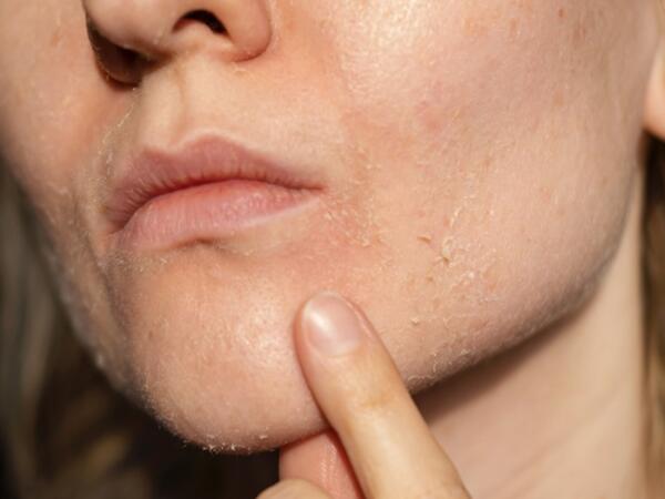 Soyuq havada quru dəri problemindən necə xilas olaq?