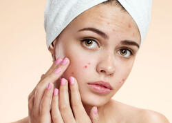 Sızanaqlardan təbii yollarla qurtulmağın effektiv üsulları