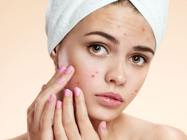 Sızanaqlardan təbii yollarla qurtulmağın effektiv üsulları