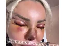 Türkiyəli məşhur 45-ci estetik əməliyyatını keçirdi - <span class="color_red">VİDEO</span>