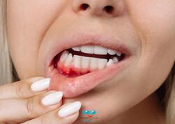 Sadə görünür, amma təhlükəlidir - Diş əti qanaması nəyin xəbəridir?