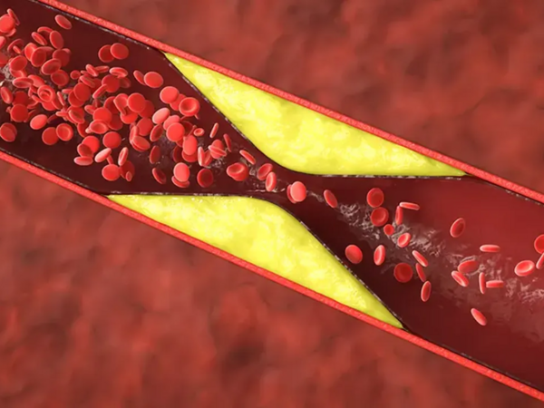 Tıxanmış ürək damarları üçün 3 güclü RESEPT