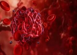 Tromb ola biləcəyini göstərən əsas narahatedici ƏLAMƏTLƏR