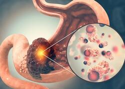 Mədə xərçəngi xəstələrinin 5 ortaq xüsusiyyəti aşkarlandı