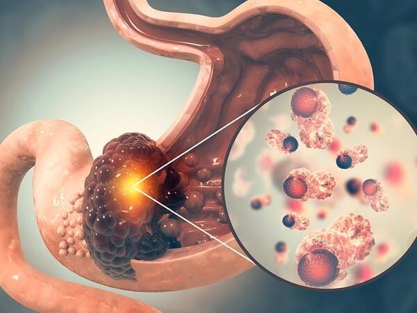 Mədə xərçəngi xəstələrinin 5 ortaq xüsusiyyəti aşkarlandı