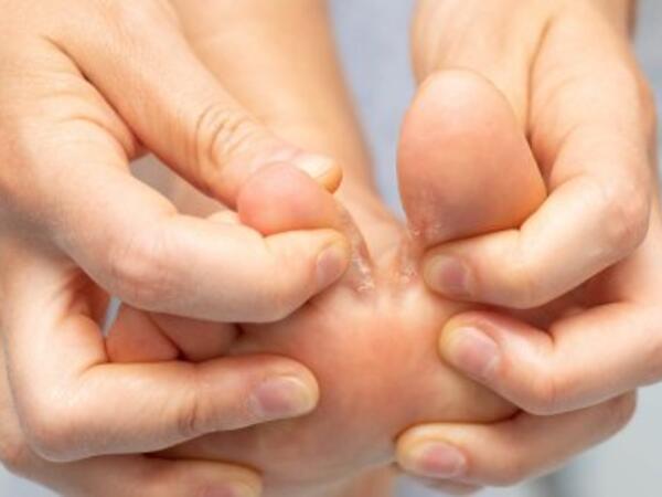 Ayaq və əllərdə göbələk varsa, belə edin