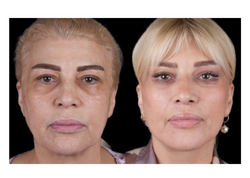 Azərbaycanın üzünü gərdirib, gözünün dartdıran MƏŞHURLARI - <span class="color_red">FOTOlar</span>