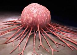 Xərçəng halları niyə atır? - SƏBƏBLƏR