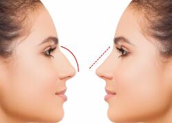 Azərbaycanda bu şəxslərə burun əməliyyatı pulsuz OLDU