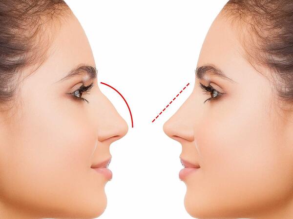 Azərbaycanda bu şəxslərə burun əməliyyatı pulsuz OLDU