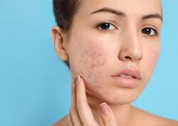 Dəri ləkələrinin gizli səbəbi görün nə İMİŞ - Balacadan yaşlıya hamı istifadə EDİR