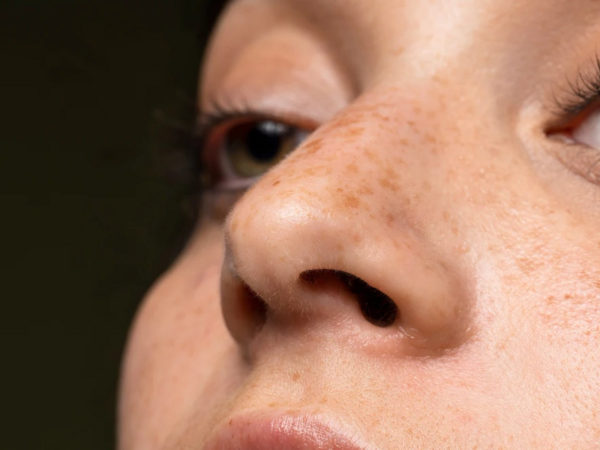 Üzdəki piqment ləkələrinin bilinməyən SƏBƏBİ