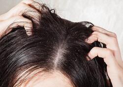 Kəpəyi yox edən təbii üsullar