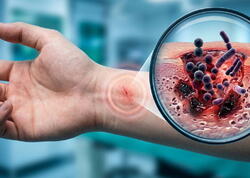 "Ət yeyən bakteriya" - Sürətlə yayılan ölümcül infeksiya haqqında bilməli olduqlarınız