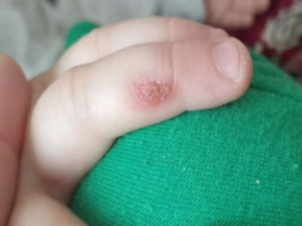 Bağçada müəllim bıçağı qızdıraraq uşağın əlinə xəsarət yetirib? - Rəsmi AÇIQLAMA