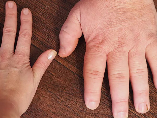 Akromeqaliya: Böyümə hormonu artıqlığının əlamətləri, diaqnozu və müalicəsi