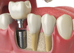 Cənubi Koreyada bir gündə 11 diş implantı qoyulan 75 yaşlı qadın öldü