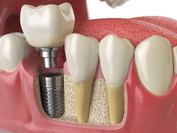 Cənubi Koreyada bir gündə 11 diş implantı qoyulan 75 yaşlı qadın öldü