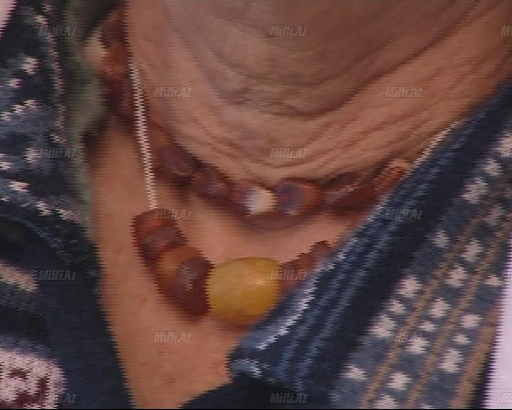 Kəhrəba daşı və zob xəstəliyi - FOTO