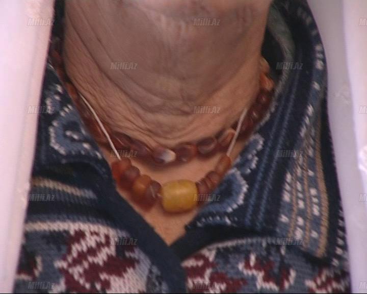 Kəhrəba daşı və zob xəstəliyi - FOTO